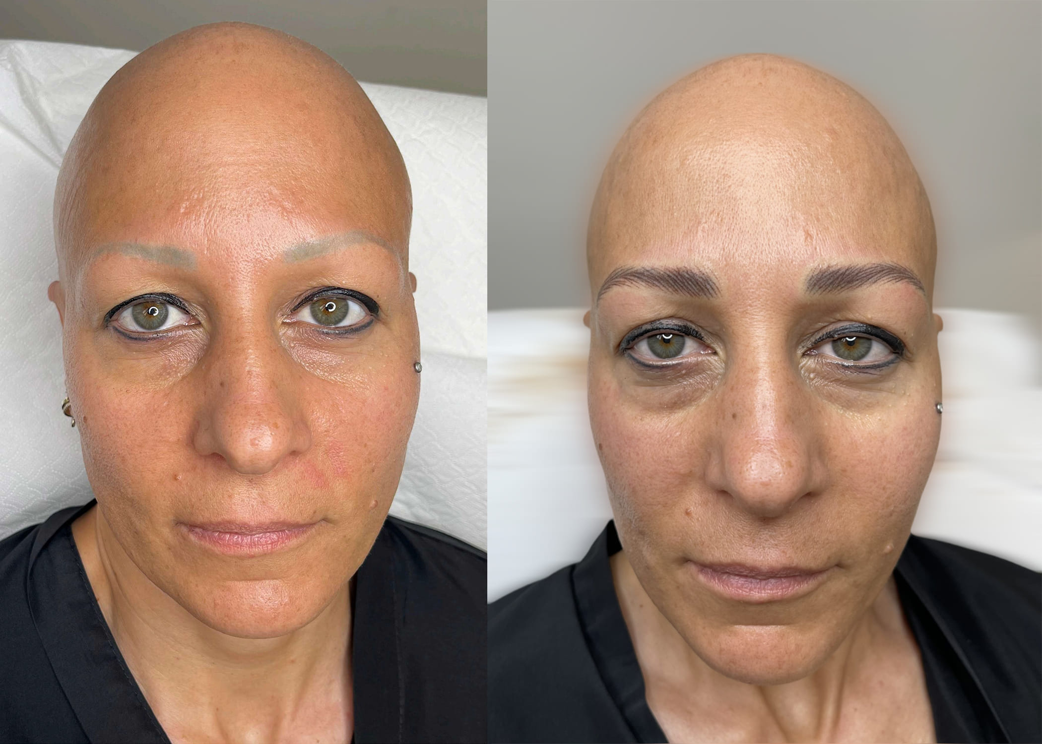 alopecia femminile - CORSO SOPRACCIGLIA REALISTICHE E ALOPECIA